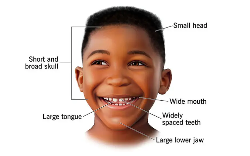 Angelman Syndrome: Occupational Therapy-centred Intervention for Functional Independence
