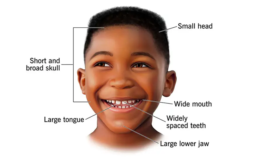 Angelman Syndrome: Occupational Therapy-centred Intervention for Functional Independence